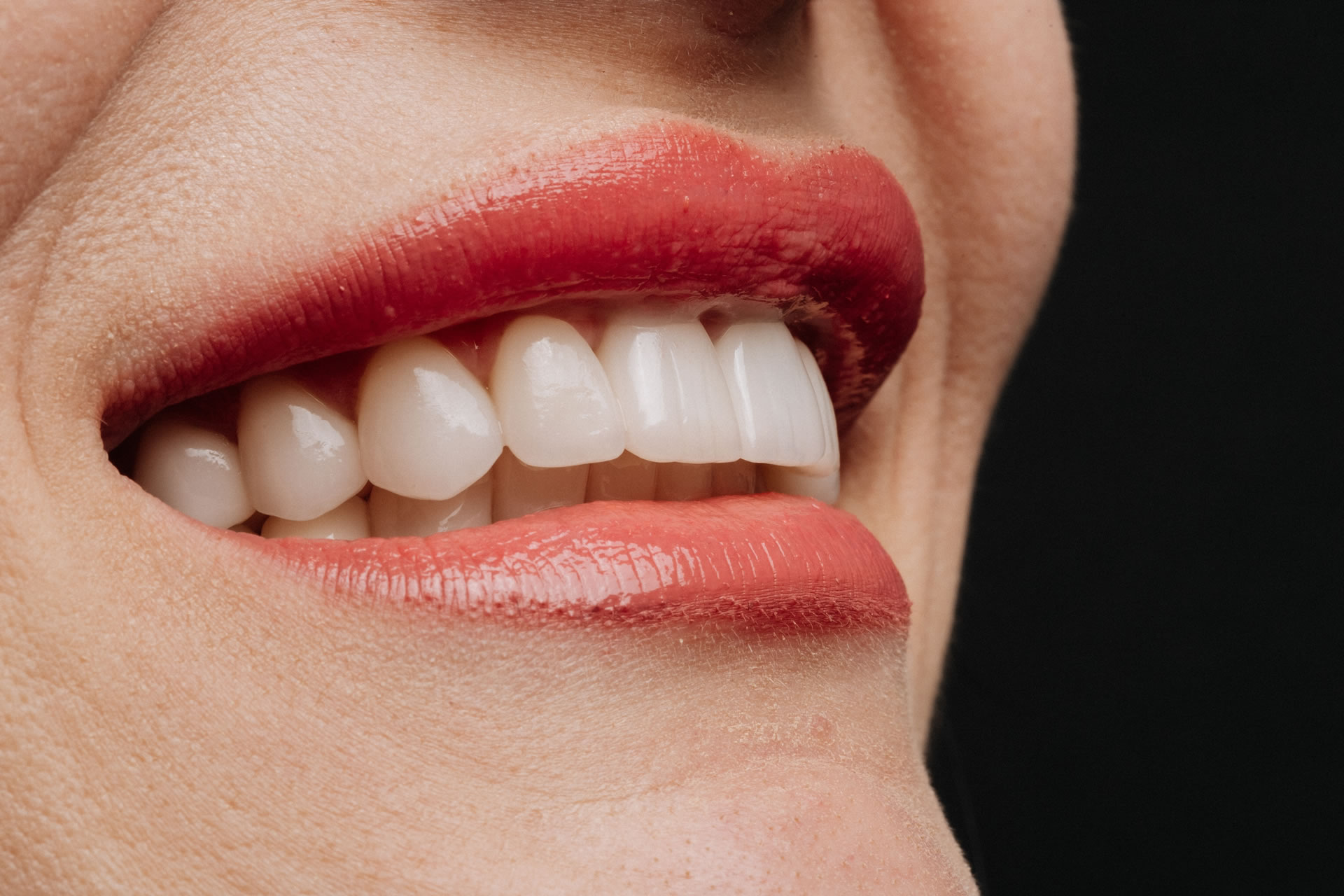 Clareamento Dental